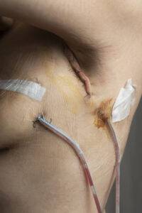 Dreenit rintasyöpäleikkauksen jälkeen vähentämässä kudosnestettä leikkausalueella.