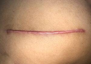 Leikkaushaavan paraneminen