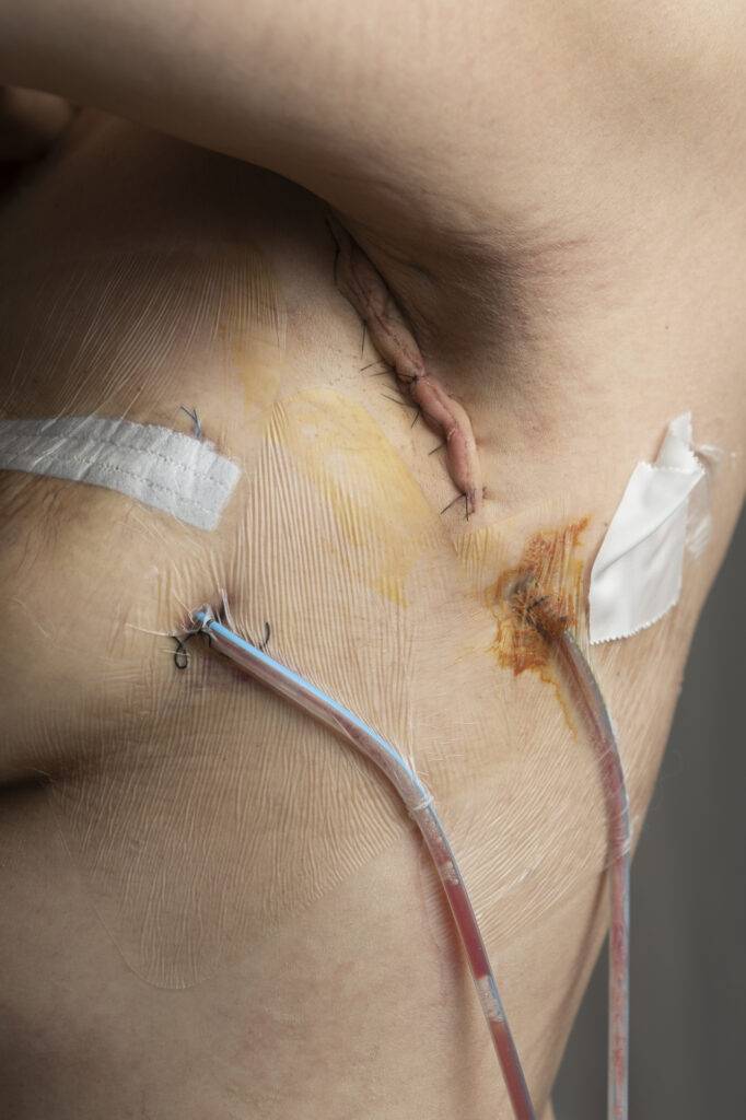 Dreenit rintasyöpäleikkauksen ja kainalon imusolmukkeiden poiston jälkeen.