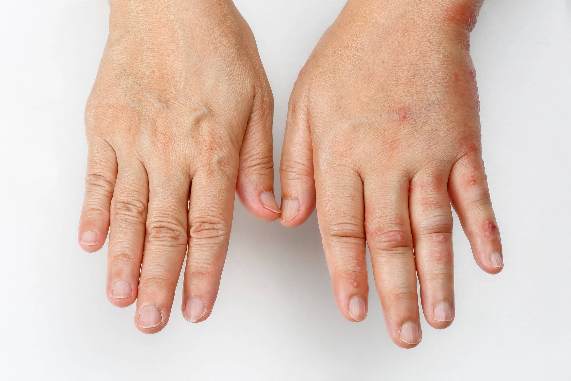 Käden turvotus rintasyöpäleikkauksen jälkeen johtuu usein lymfaturvotuksesta