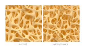 mit-tarkoittavat-osteoporoosi-ja-osteopenia-sek-mist-ne-johtuvat